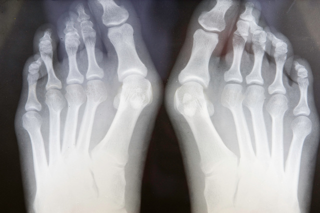 Grungy X-ray Of Feet With Bunions